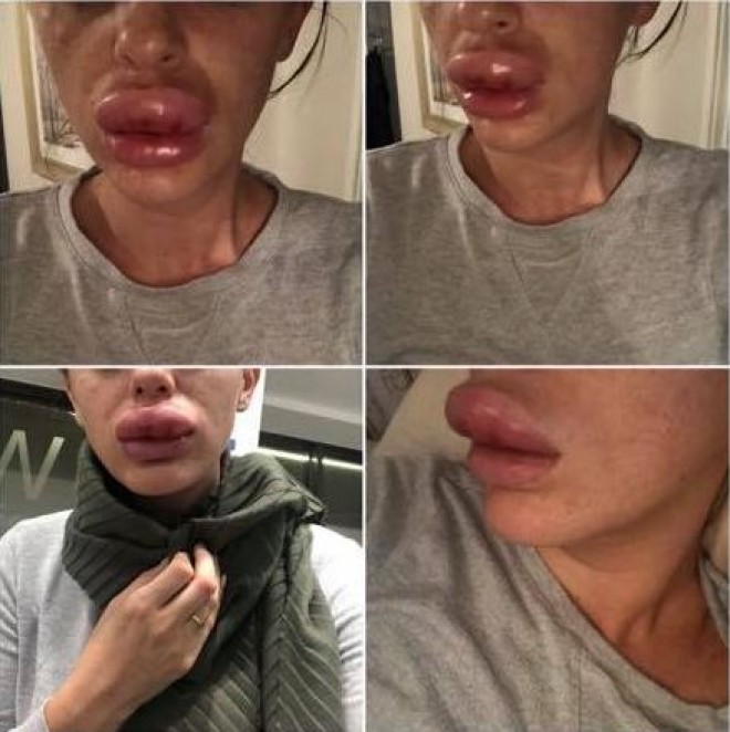 Buzele unei tinere la un pas de a exploda după injecțiile cu Botox. Asistentele au râs de ea când a ajuns la spital