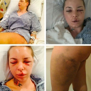 Imagini terifiante cu starleta porno care a fost snopită în bătaie de fostul ei iubit! Chipul şi trupul divei XXX sunt un DEZASTRU!