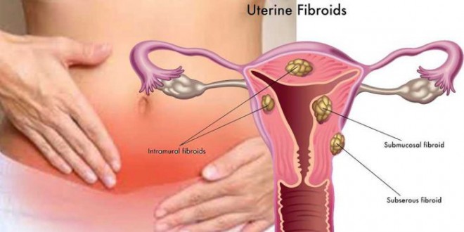 Tratamente Naturiste pentru fibrom