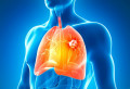 Studiu revoluţionar al specialiştilor: Vitamina-minune care te scapă de cancerul pulmonar
